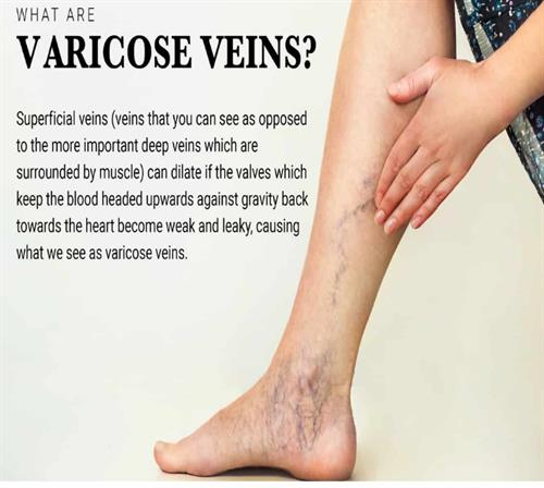 Varicose Vein Patch